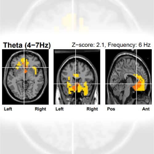 sLORETA visualization of the human brain